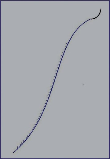 Aptos Suture, scheme of the wound suturing