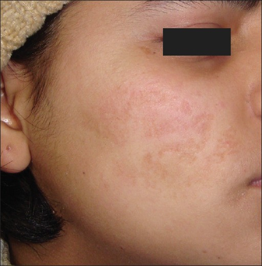 Post-herpetic scarring before treatment