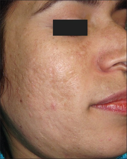 Post-acne scarring before treatment