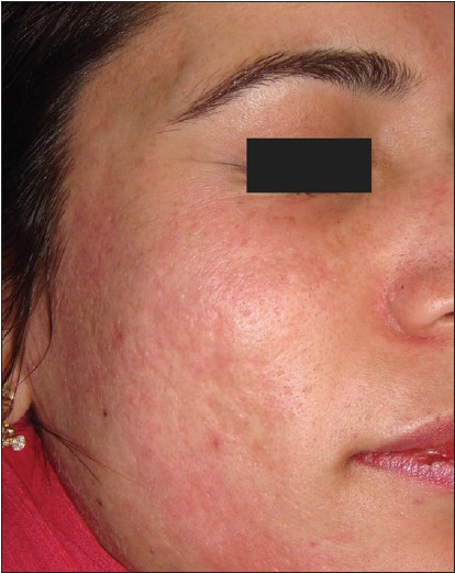 Post-acne scars after dermaroller treatment