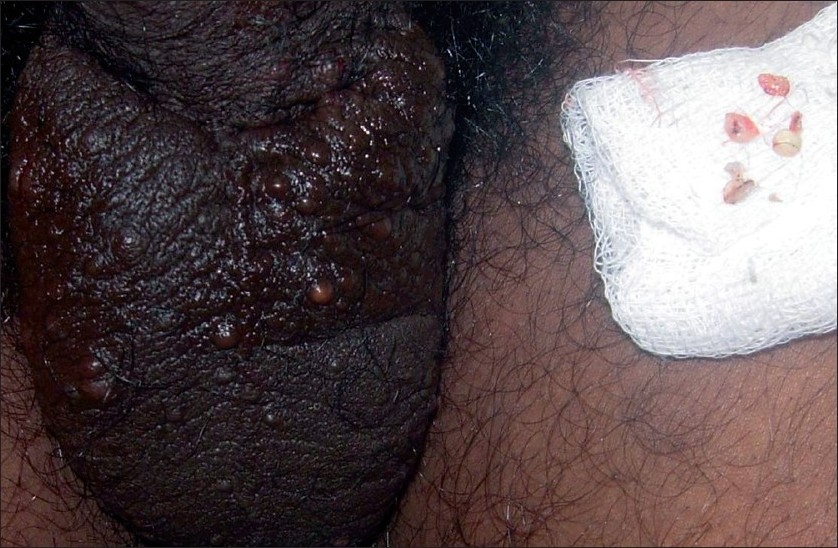 Extracted cysts placed on the gauze-piece