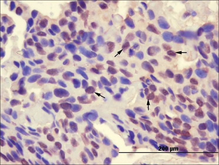 Basal cell carcinoma cells showing nuclear staining pattern (arrows) with the anti-IRF-1 antibody (× 400)