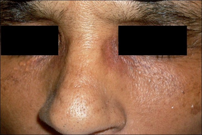 After two sittings of Q-switched ND:YAG laser