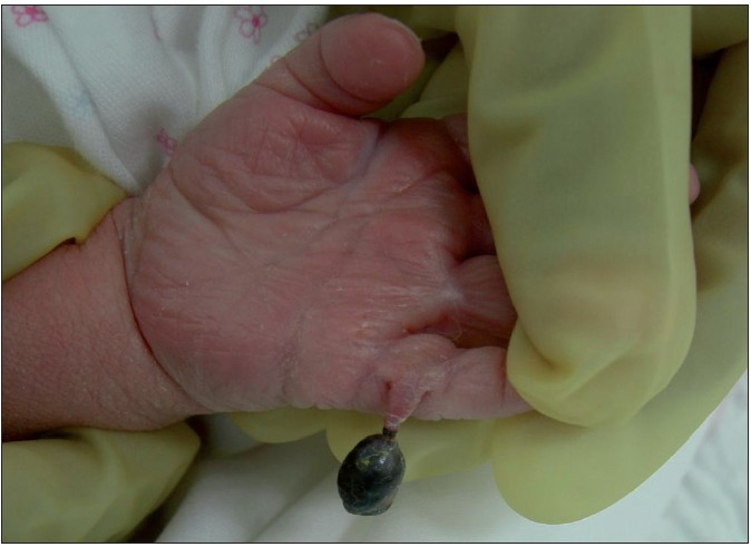 Torsion of polydactyly