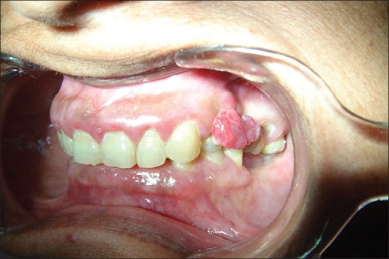 A discrete nodular, erythematous enlargement covering almost two-third of the crown of 24