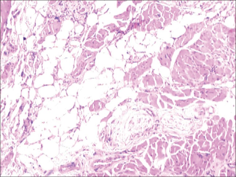 Microphotograph showing mature fat cells with nuclei located peripherally, diffusely infiltrating the skeletal muscle fibres (H and E, 100×)