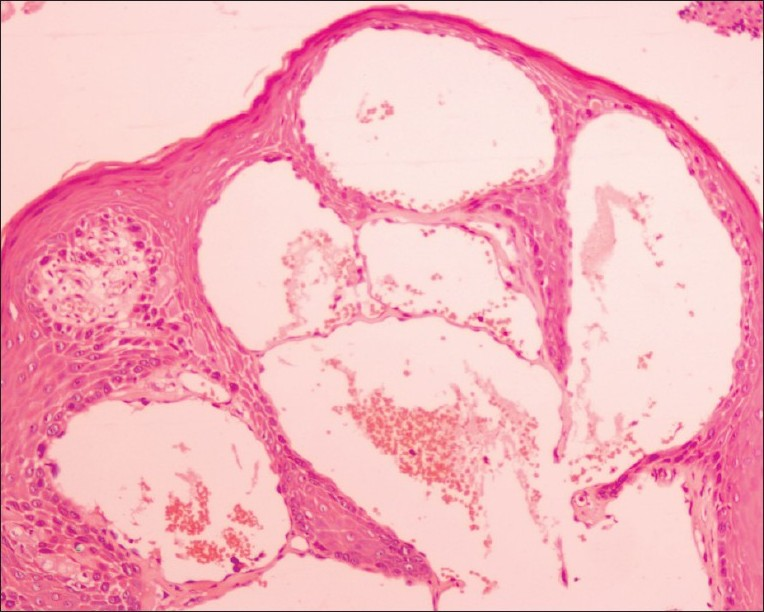 Photomicrograph shows epidermal hyperkeratosis, acanthosis with vascular ectasia and erythrocytes in the dilated capillaries (haematoxylin and eosin, magnification, ×100)