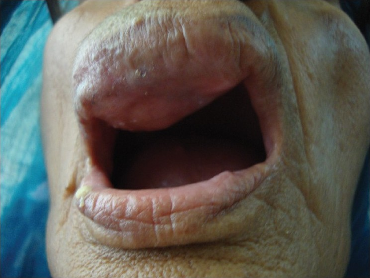 Clinical photograph of a firm, fixed swelling of the upper lip measuring 2 × 1.5 cm