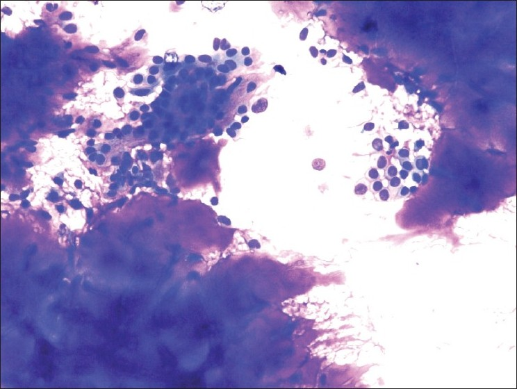 FNA smears reveal sheets of epithelial cells and abundant fibromyxoid stroma (MGG; ×200)