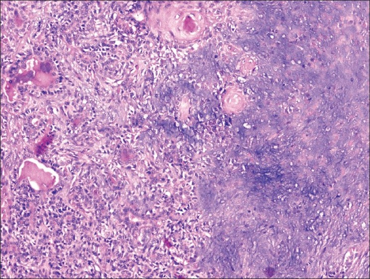 Microsections reveal ducts and acini with a preserved myoepithelial cell layer in chondromyxoid stroma (H and E; ×100)