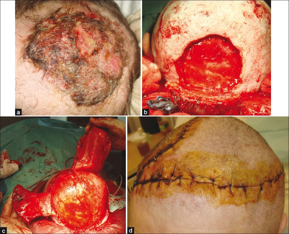 Giant metatypic (basosquamous) basal cell carcinoma of the scalp; (a) Clinical presentation; (b) Defect after complete excision; (c) Preparation of dual rotational flaps; (d) Eight days after surgery