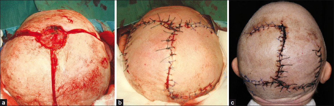 Giant basal cell carcinoma of the scalp (a) Defect after tumor removal and preparation of windmill flaps; (b) Defect closure; (c) Seven days after surgery