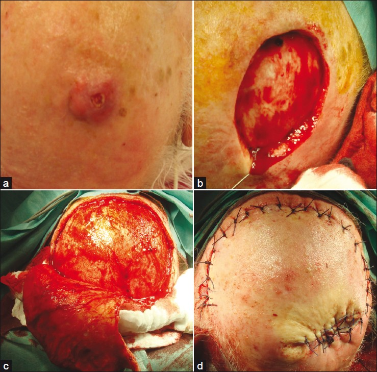 Desmoplastic squamous cell carcinoma of the scalp; (a) Clinical presentation of an ill defined nodular tumor; (b) Defect after Mohs delayed surgery; (c) Preparation of a rotational flap; (d) Defect closure