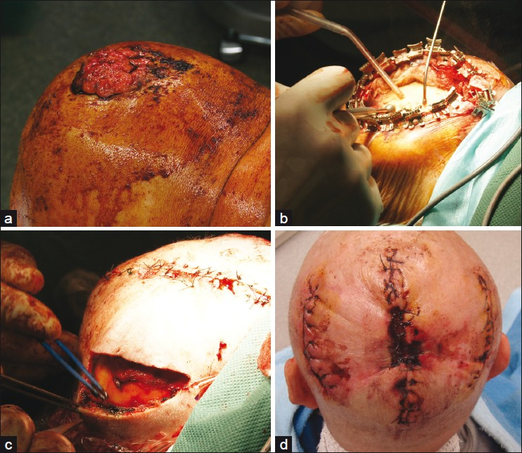 Giant squamous cell carcinoma of the scalp; (a) Clinical presentation; (b) After complete excision preparation of the outer tabula by diamond drill; (c) Defect closure was achieved by combined tissue advancement and extension. The primary defect has already been closed; (d) Five days after surgery