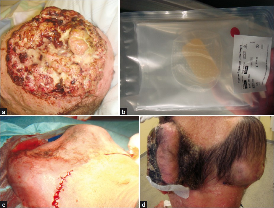 Giant tricholemmal squamous cell carcinoma; (a) Clinical presentation; (b) Osmotic expander; (c) Implantation of two expanders in the occipital region; (d) After 6 weeks of tissue expansion with a final volume of 300 mL each