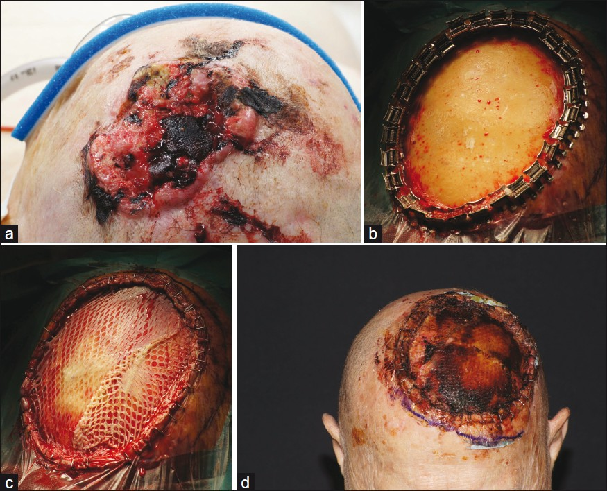 Giant squamous cell carcinoma of the scalp; (a) Ulcerated, ill-defined tumor; (b) After complete excision with removal of periost and partial removal of the outer tabula. Bleeding was stopped by bony wax. Only some minor bleedings can be seen to feed the transplant; (c) Sandwich transplantation: elastin-collagen template was placed above the bone and a split skin mesh-graft transplant was fixed above in the same session; (d) Stable transplant after 8 days