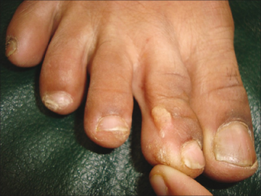 Recurrent wart on the lateral aspect of the right second toe