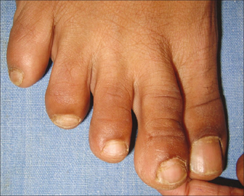 Complete resolution of the wart after autoimplantation