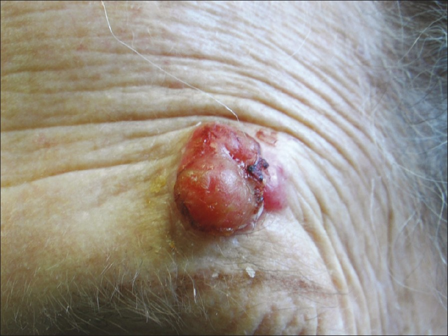 Cutaneous squamous cell carcinoma