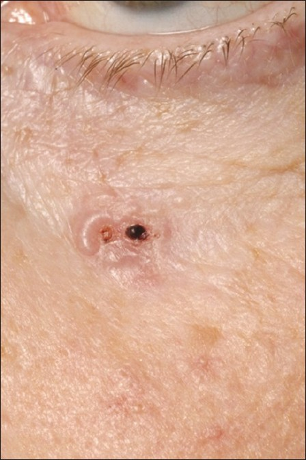 Nodular basal cell carcinoma