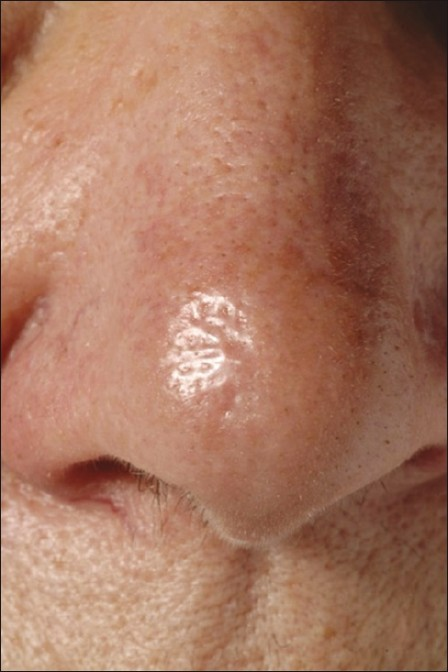 Morphoeic basal cell carcinoma on nasal tip