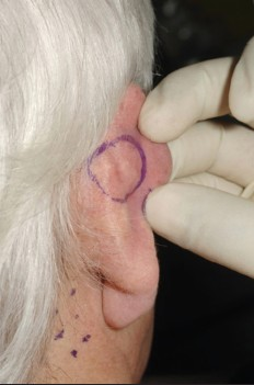 BCC right dorsal ear