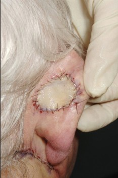 Wound post Mohs surgery repaired with skin graft