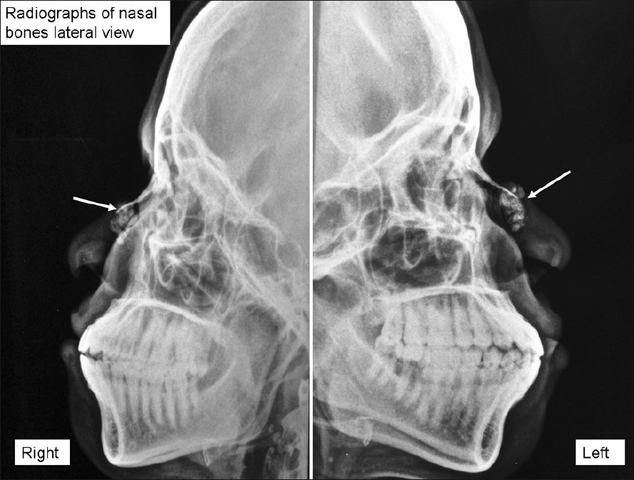 Radiographs of the nasal bones showing subcutaneous calcification