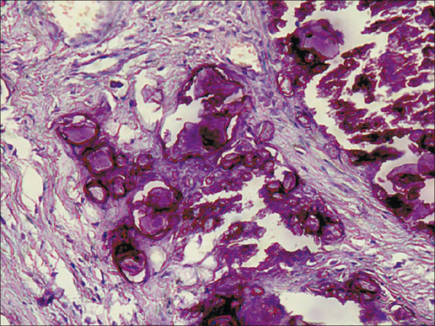 Haematoxylin and eosin staining showing calcium deposits and foreign body reaction