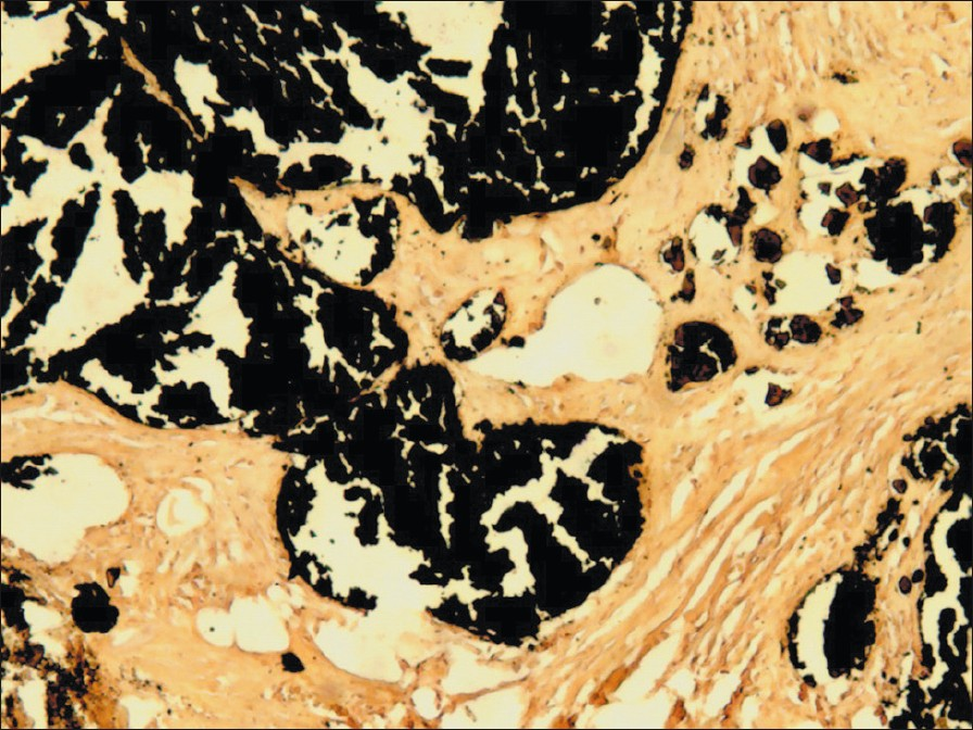 Confirmation of calcium deposits with von Kossa staining (black deposits)