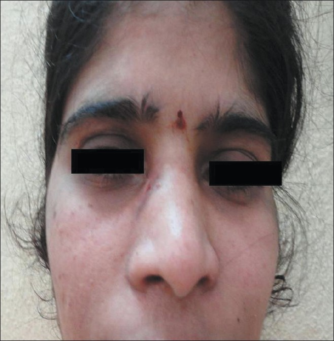 Post-operative result after augmentation with silicone