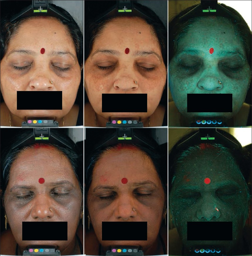 Typical photographs obtained with the Canfield VISIA CR® device (Canfield Imaging Systems, Fairfield, USA); From left to right, Skin VISIA standard flash, Cross Polarised and c-Ultra violet-A (UVA) lightening, respectively