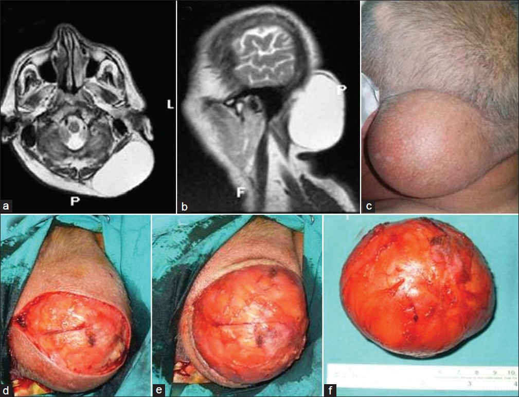 (a) Axial and (b) sagittal T2-weighted MR imaging shows the giant lipoma; (c) the lipoma in the occipital region; (d) the capsule of the lipoma after skin incision; (e) the resected lipoma peeled off from the surrounding tissue and removed together with the capsule; (f) picture of the completely resected lipoma