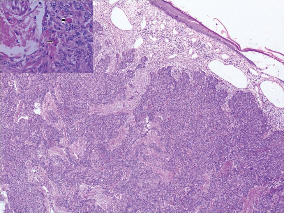 Low power view of tumor in dermis consisting of proliferating nests of squamoid cells separated by fibrous stands (H&E ×100). Inset {High power view of tumor showing foci of keratinization and areas of necrosis (H&E ×400)}.