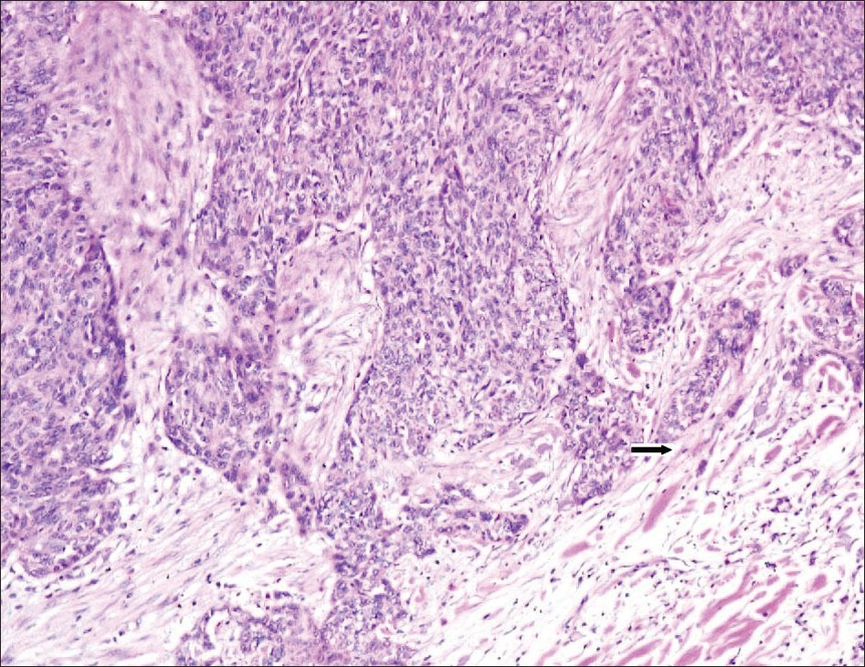 Deeper margins of the tumor showing small nests of tumor cells infiltrating the skeletal muscle (H&E ×400).