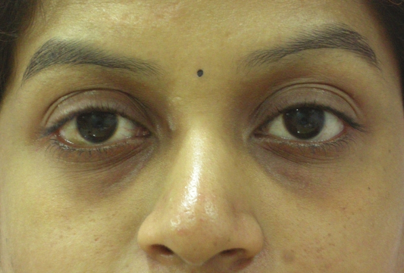 Tear trough deformity resulting in dark circles in a young Indian female