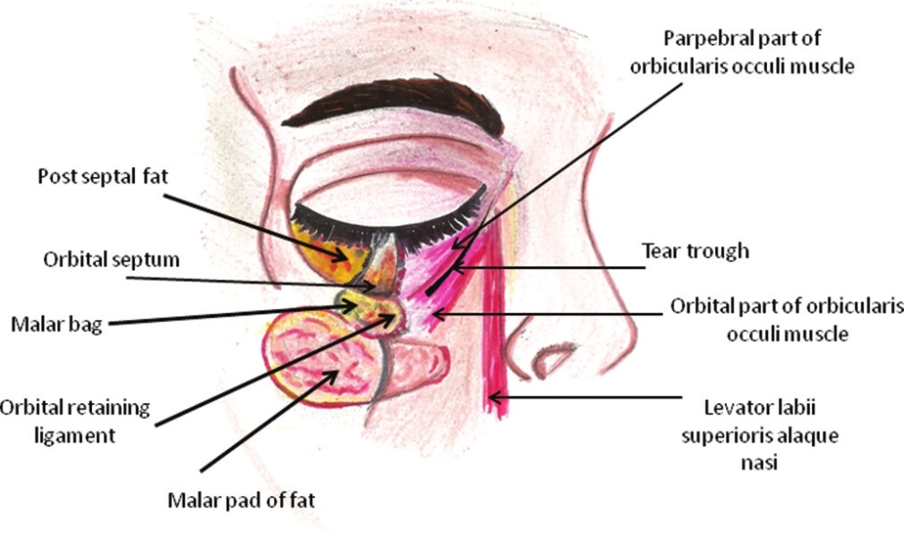 Anatomy of tear trough deformity