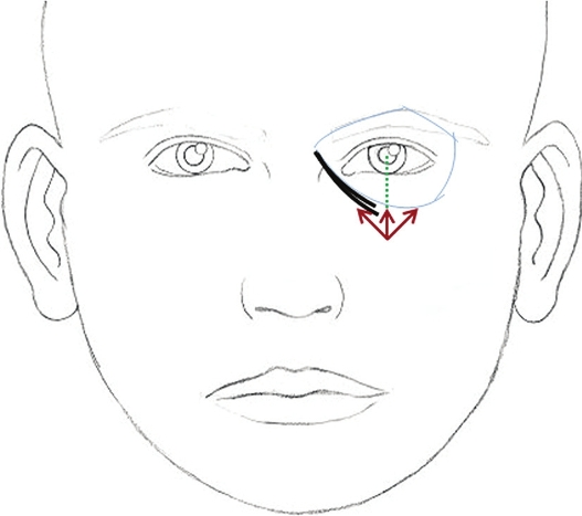 Marking of tear trough filler (injection points and direction of needle)