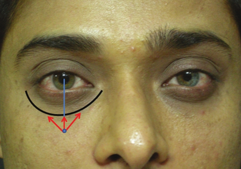 Marking of tear trough filler