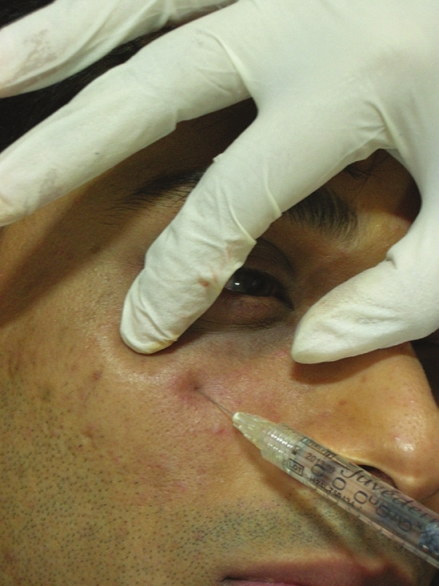 Subperiosteal injection of hyaluronic acid filler towards lateral canthus