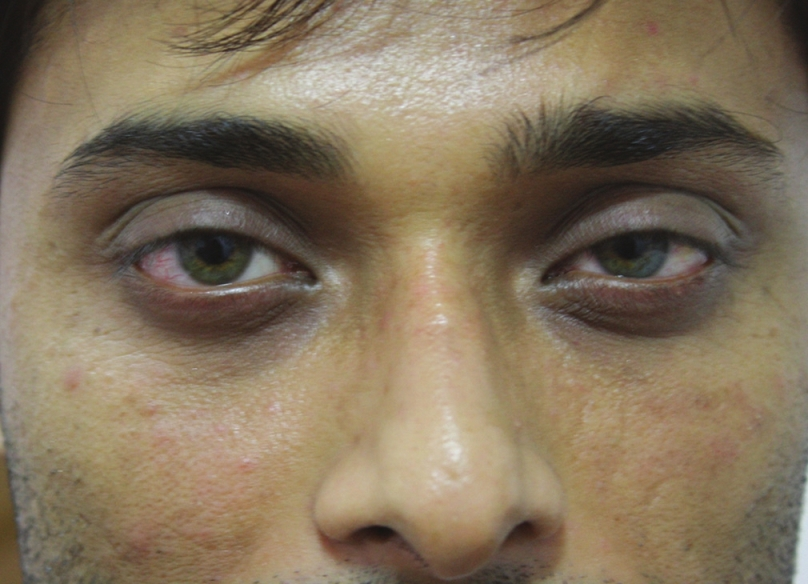 Male: Before tear trough filler treatment