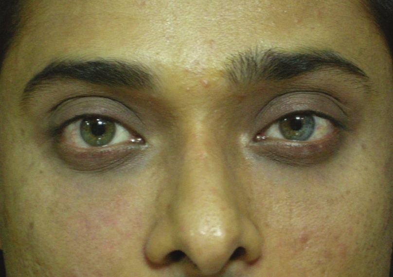 Male: After tear trough filler treatment