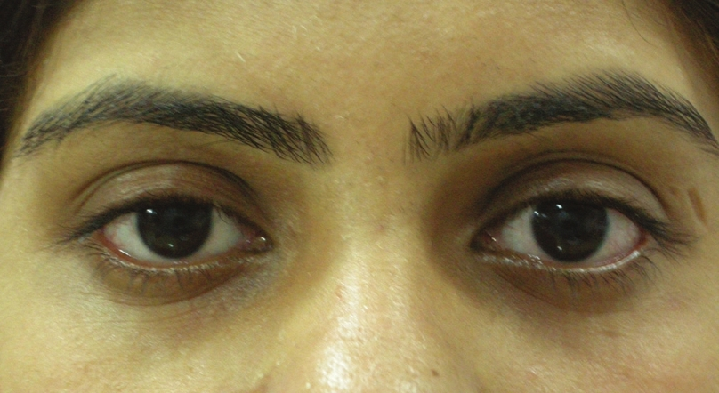 Female: Before tear trough filler treatment