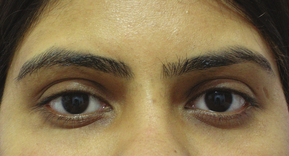 Female: After tear trough filler treatment