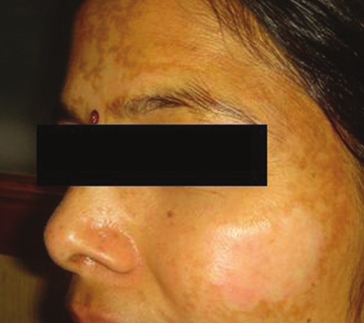 Hypopigmentation seen post-peel