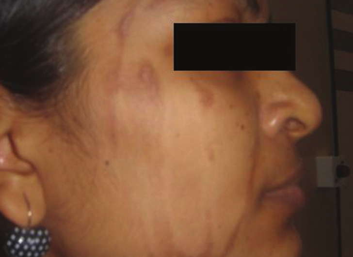 Hyperpigmentation post-peel