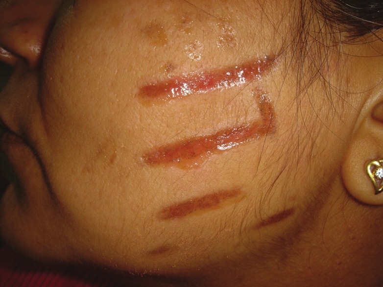 Scarring seen on left cheek after peel