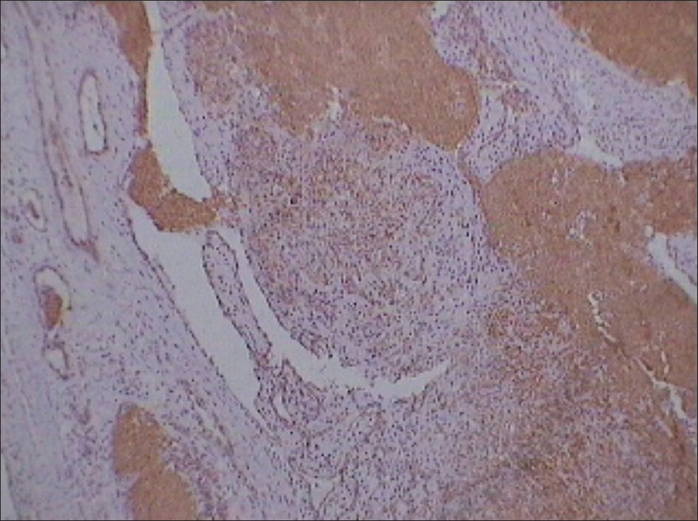 A photo micrograph showing variably sized blood vessel which were lined by plump endothelial cells