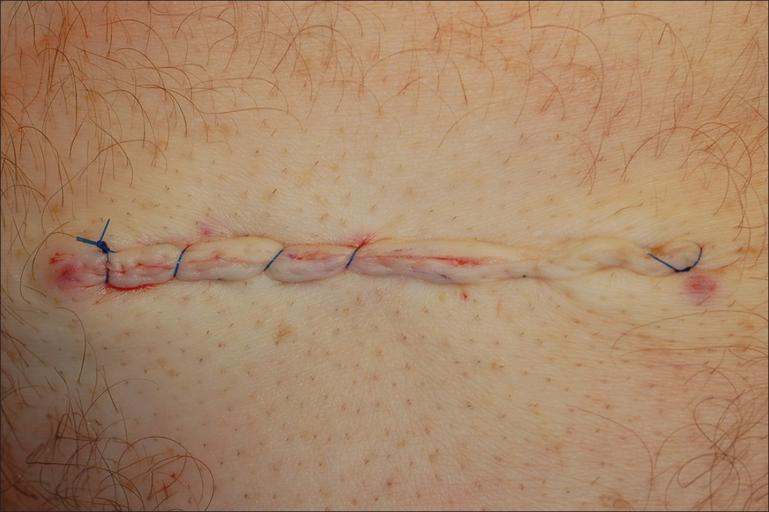 Post-operative result demonstrating the difficulty in visualizing the suture with a standard horizontal running mattress suture in the right half versus our technique, a combination of a horizontal running mattress suture modified with intermittent simple loops, in the left half of the sutured wound. Post-operative result immediately after combination stitch: Wound edge eversion and good hemostasis are achieved