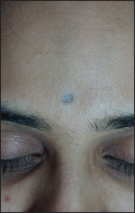 (a) green-blue bindi tattoo on the forehead. No appreciable improvement after eight sittings with conventional QS NdYag laser